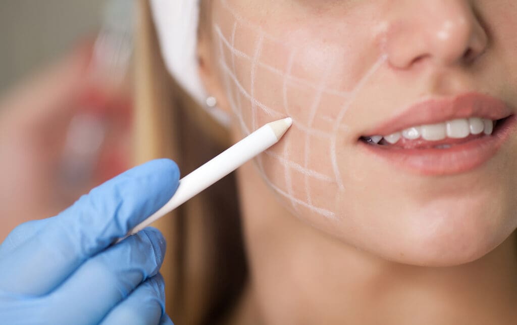 A close-up of a woman’s face with grid lines drawn on her cheek in white pencil. A gloved hand holds the pencil, preparing for a cosmetic procedure. The woman is smiling slightly and wearing a headband.